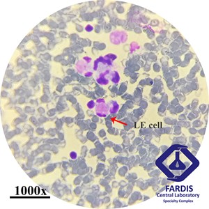 LE(lupus erythematosus) Cell