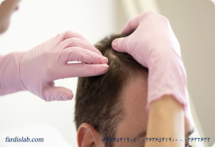 آزمایش ژنتیک برای ریزش مو