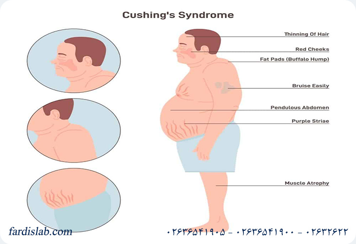 تفاوت بیماری کوشینگ و سندرم کوشینگ تفاوت بیماری کوشینگ و سندرم کوشینگ