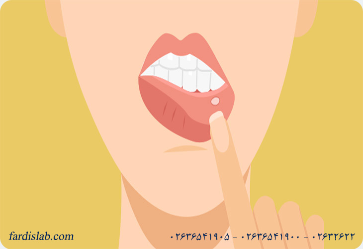 تفاوت آفت دهان و سرطان دهان