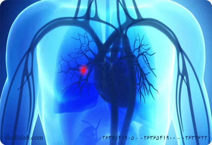 چه چیزی باعث آمبولی ریه میشود؟ چه چیزی باعث آمبولی ریه میشود؟