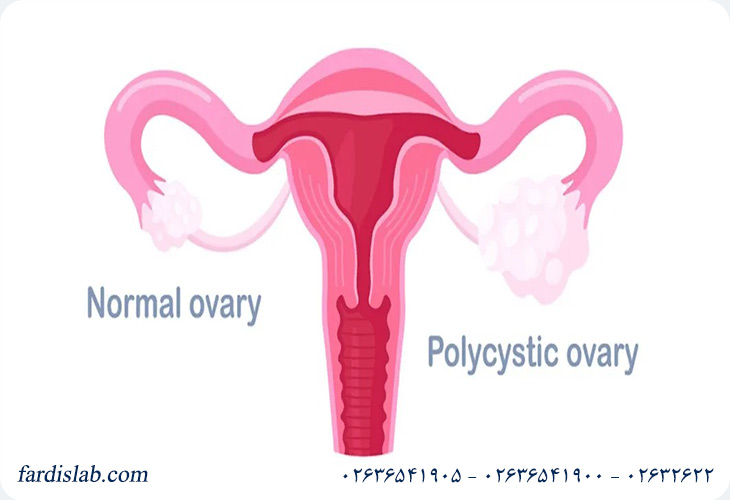 راهکارهای پیشگیری از دیابت در زنان مبتلا به PCOS راهکارهای پیشگیری از دیابت در زنان مبتلا به PCOS