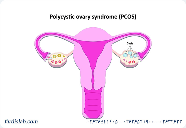 چگونه کنترل PCOS به کاهش خطر دیابت نوع ۲ کمک میکند؟ چگونه کنترل PCOS به کاهش خطر دیابت نوع ۲ کمک میکند؟