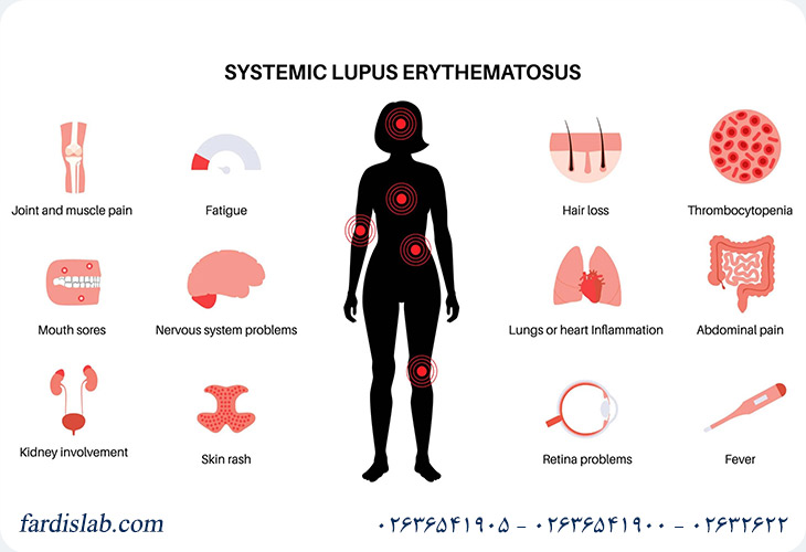 آشنایی با انواع بیماری لوپوس 