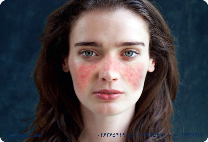 Why are women more likely to get lupus than men