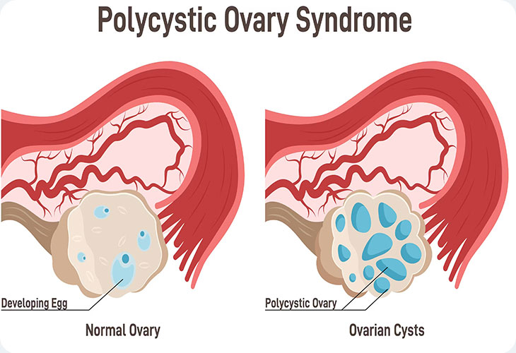 تخمدان پلی کیستیک چیست؟
