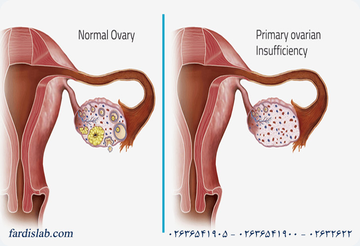 تفاوت تخمدان پلی کیستیک با تنبلی تخمدان چیست؟