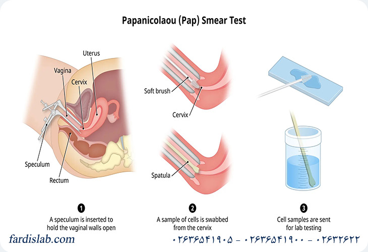 انواع تست پاپ اسمیر انواع تست پاپ اسمیر