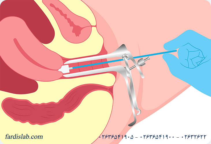 آزمایش پاپ اسمیر چه چیزی را مشخص میکند؟ آزمایش پاپ اسمیر چه چیزی را مشخص میکند؟