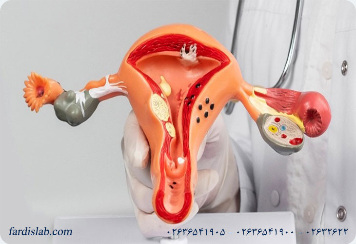 آیا تخمدان پلی کیستیک خطرناک است؟