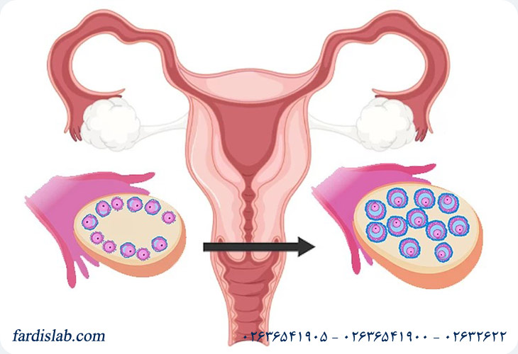 تنبلی تخمدان چیست؟