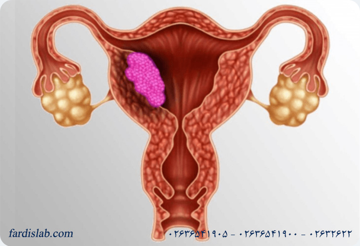 عوارض سرطان دهانه رحم و پیامدهای عدم درمان