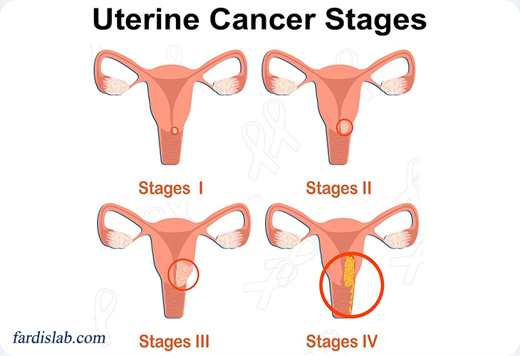 انواع سرطان رحم و تفاوت آن‌ها با هم