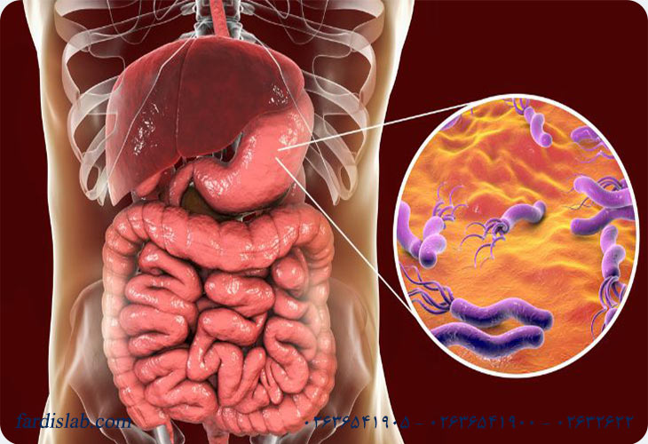 ارتباط بین هلیکوباکتر پیلوری و زخم معده