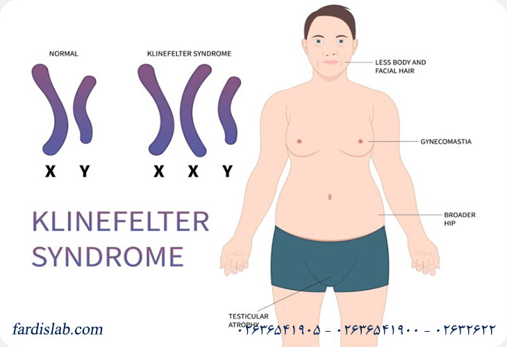 علائم سندرم کلاین فلتر