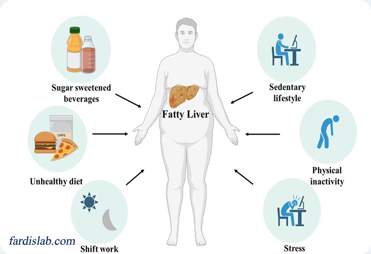 علت ابتلا به کبد چرب علت ابتلا به کبد چرب