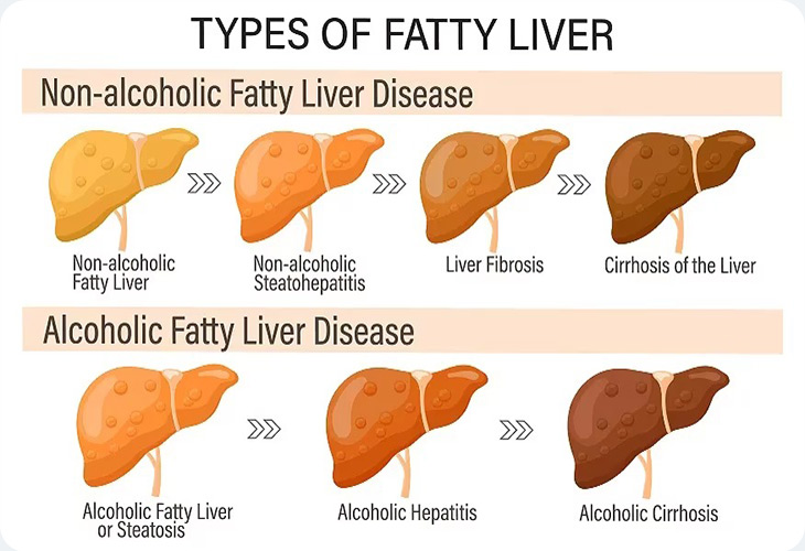 انواع کبد چرب انواع کبد چرب