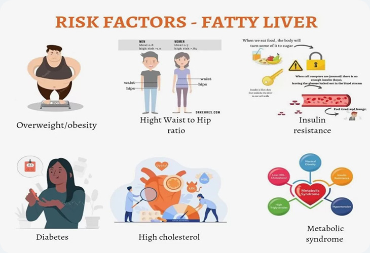 چه کسانی در معرض خطر ابتلا به بیماری کبد چرب هستند؟ چه کسانی در معرض خطر ابتلا به بیماری کبد چرب هستند؟