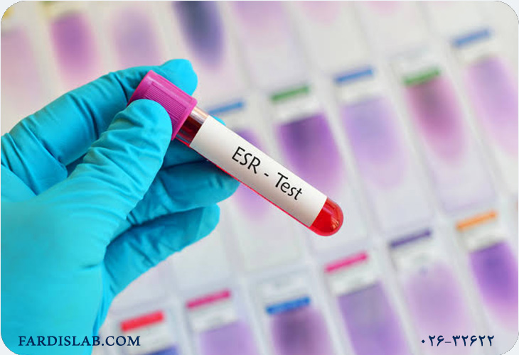 انجام آزمایش ESR در چه حالتی لازم است؟ انجام آزمایش ESR در چه حالتی لازم است؟