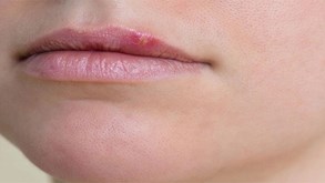 آیا تبخال لب باعث تبخال دستگاه تناسلی می‌شود؟