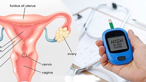 ارتباط سندرم تخمدان پلی‌ کیستیک و دیابت