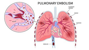 آمبولی ریه چیست و چه خطری دارد؟