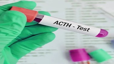 آزمایش ACTH چیست؟