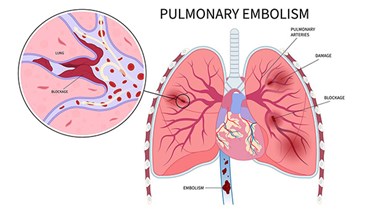 آمبولی ریه چیست و چه خطری دارد؟