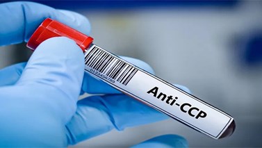 آزمایش Anti-CCP برای چیست؟