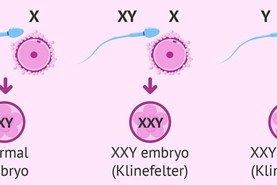همه چیز درباره سندرم کلاین‌ فلتر