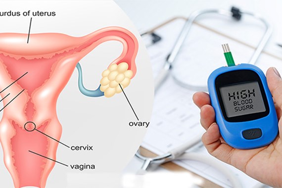 ارتباط سندرم تخمدان پلی‌ کیستیک و دیابت