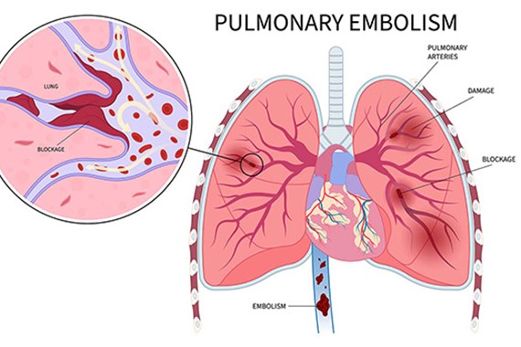 آمبولی ریه چیست و چه خطری دارد؟