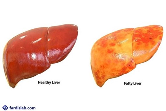 کبد چرب چیست؟ علائم، علت، تشخیص و آزمایش‌های لازم