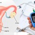 ارتباط سندرم تخمدان پلی‌ کیستیک و دیابت