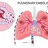 آمبولی ریه چیست و چه خطری دارد؟