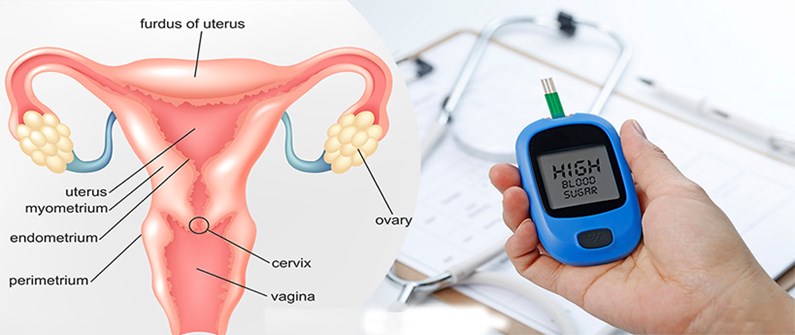 ارتباط سندرم تخمدان پلی‌ کیستیک و دیابت