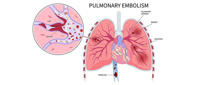 آمبولی ریه چیست و چه خطری دارد؟